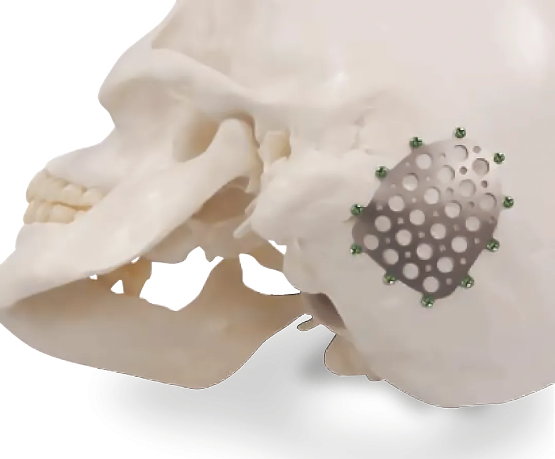 ilustracion de implantes neuro plate marca zimmer biomet colocados